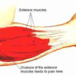Tennis Elbow – Sore Elbow or Do I Have It?
