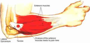 Tennis Elbow – Sore Elbow or Do I Have It?
